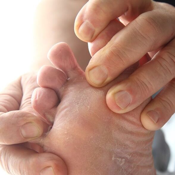 The fungus attacks the skin between the toes