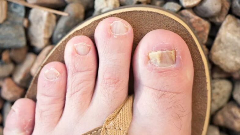 Mycosis of nails