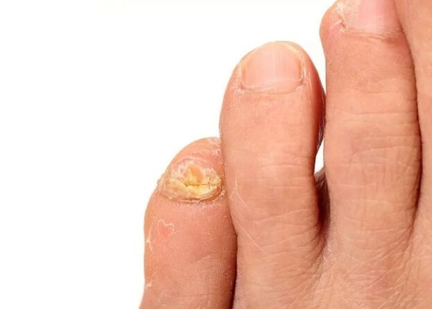 Nail fungus