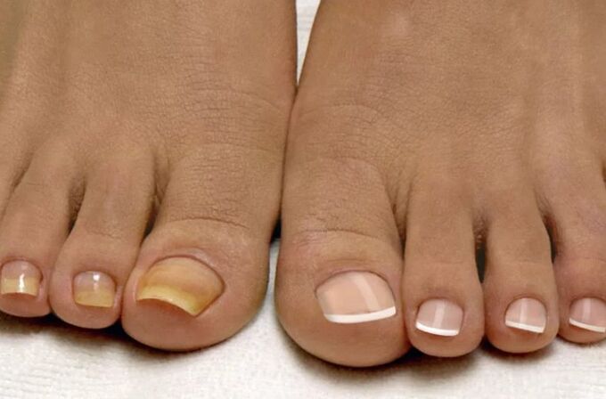 The fungus on the legs