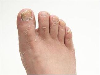 athlete's foot symptoms