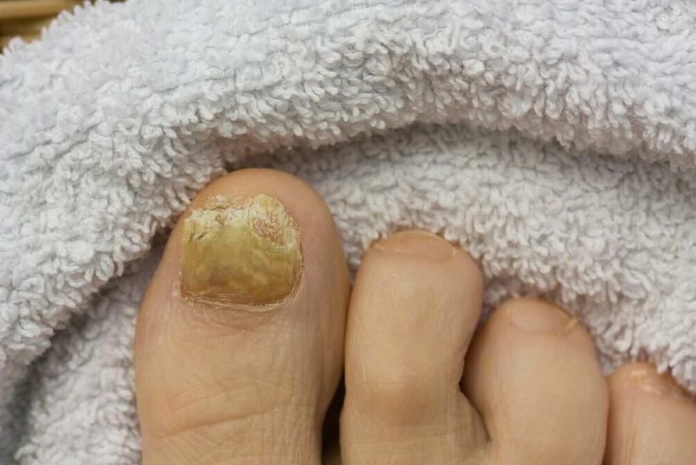 Atrophic stage of the fungus (falling toenail pieces)