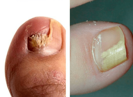 Mushroom disease