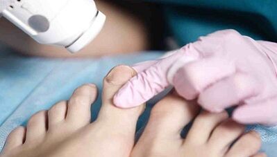 Hardware treatment of mushrooms on the legs