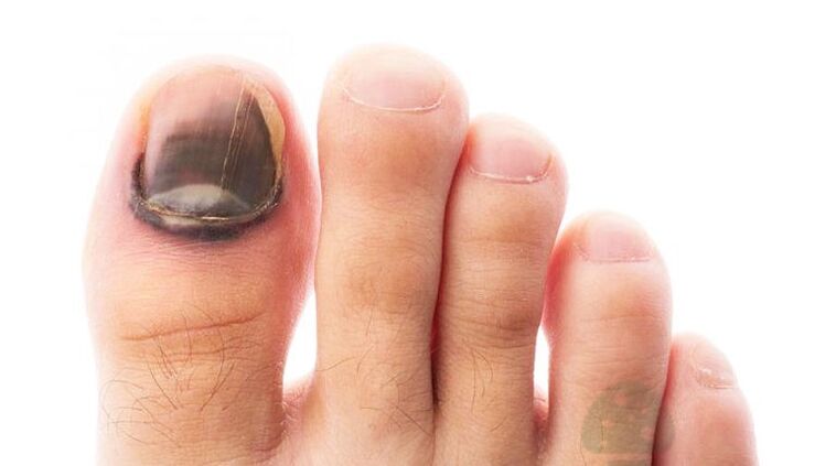 The running level of the disease with a mushroom of the thumb sagel
