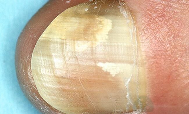 Treatment of fingertip mushrooms with internal intermediate medication