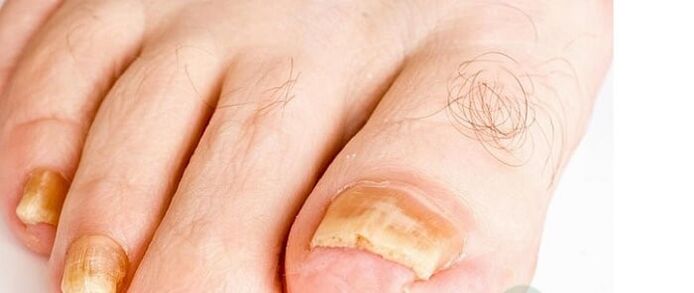 Varieties of the fingernail fungus