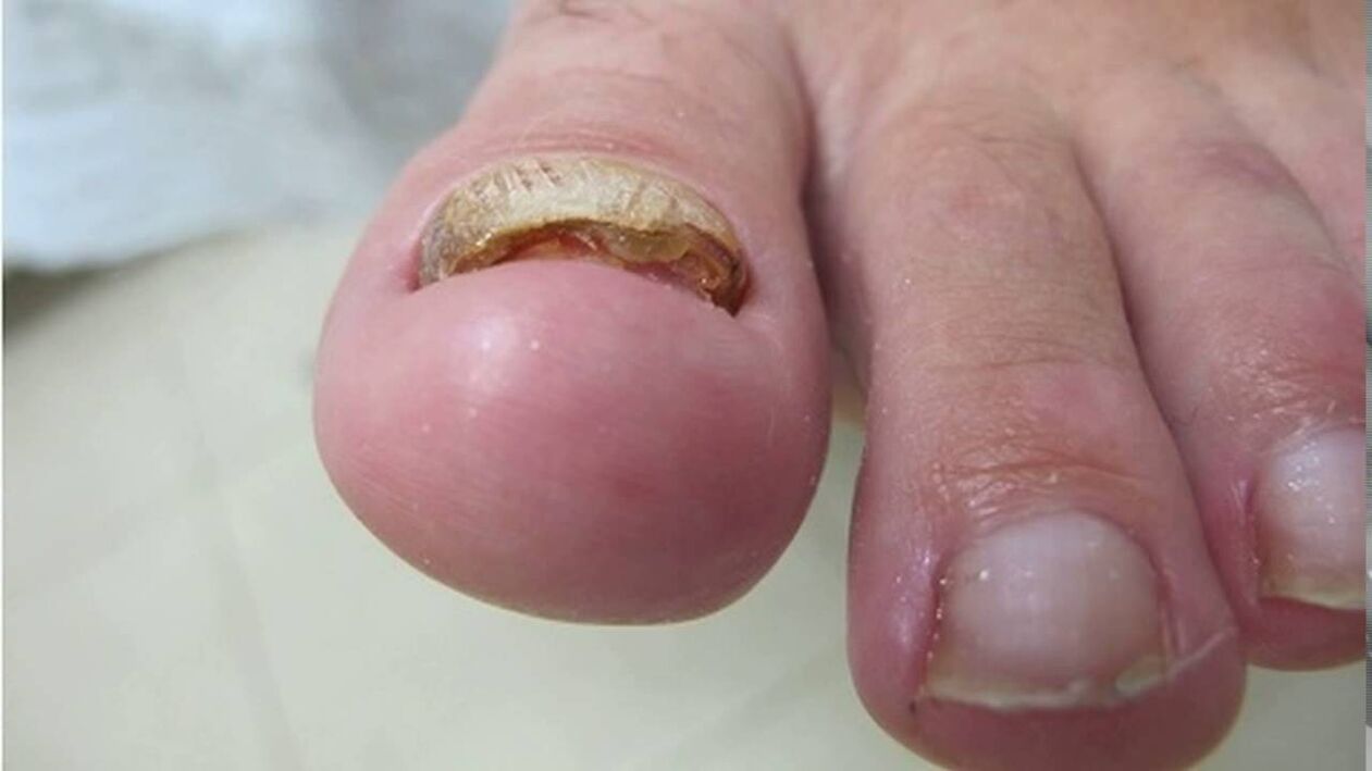 Hypertrophic fungus – edge deformation, loss of color and thickening of the nail plate