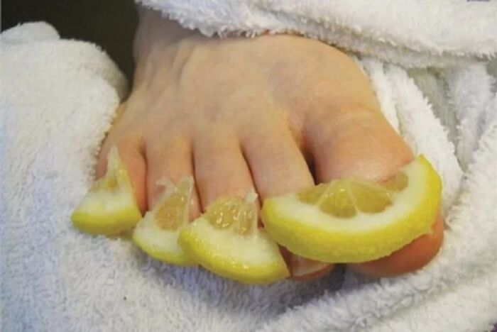 Compresses from lemon drops - a folk remedy for toenail fungus