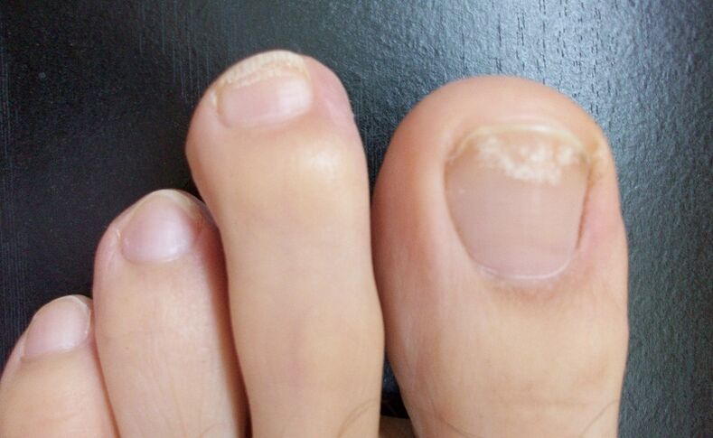 The first signs of a fungus are a change in the color of the nail plate and the appearance of spots